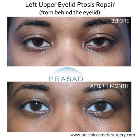 eye asymmetry icd 10.